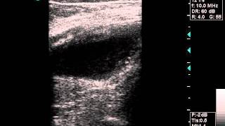 doppler ultrasound popliteal aneurysmwmv [upl. by Toinette526]