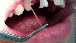 Tooth Nerve Removal [upl. by Tevis971]