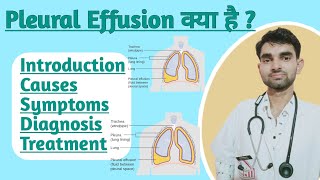 Pleural Effusion in Hindi  Causes Sign and Symptoms Treatment of Pleural effusion [upl. by Swords456]