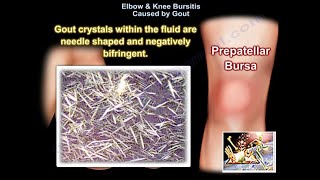 Elbow amp Knee Bursitis Caused By Gout  Everything You Need To Know  Dr Nabil Ebraheim [upl. by Bak]