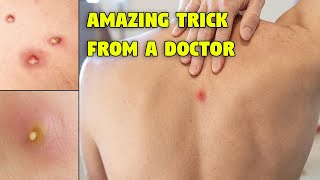 How to Get Rid of Boils Fast and Easily with This Amazing Trick from a Doctor Get Ridof Boils Fast [upl. by Evy362]