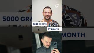 Hair Transformation in 9 Months hairtransplant trendingshorts fuehairtransplant beforeandafter [upl. by Doniv]