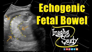 Echogenic Fetal Bowel  Ultrasound  Case 141 [upl. by Sixel]