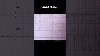 Atrial Flutter ECG Examples [upl. by Oiratnom]