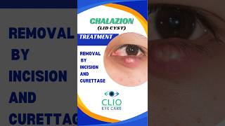 Chalazion Treatment Incision and Curettage  CLIO Eye Care [upl. by Leahcimnaj]