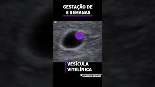 6 SEMANAS DE GESTAÇÃO  Ultrassom Obstétrico [upl. by Hadria]