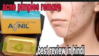 Acnil pimple clear soap review in Hindi पिम्पल कील मुहांसे पिम्पल के निशान की remove करें। [upl. by Orsa]