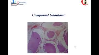 cementoblastoma and mixed odontogenic [upl. by Tegirb]