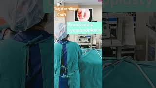 एंडोस्कोपिक टिम्पेनोप्लास्ट ENDOSCOPIC TYMPANOPLASTY endoscopicearsurgerytympanoplastyyoutube [upl. by Mulac]