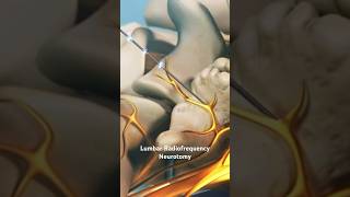 Lumbar Radiofrequency Neurotomy [upl. by Mixam919]