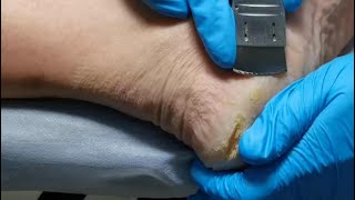 Pedicure  Look at cracked heels Dead skin removal and Cracked heels treatment [upl. by Berner]