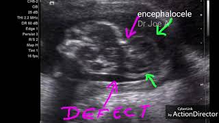 Occipital encephalocele ultrasound video [upl. by Yerkovich171]