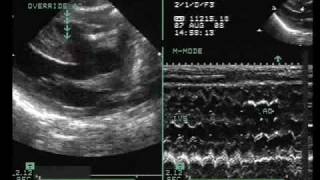 Tetralogy of Fallot with Vertically Oriented PDA [upl. by Iteerp525]