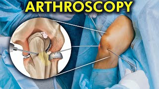 The World of Arthroscopic Surgery How Arthroscopy is performed Include 3d animation [upl. by Matejka]