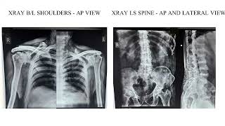 A Case of Ochronosis with Severe Bilateral Osteoarthritis Knee [upl. by Mailliwnhoj]