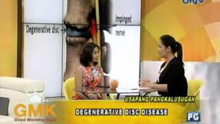 Degenerative Disc Disease [upl. by Ailimac]