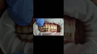 Lower implant molar bridge bite check with Bausch 40 micron articulating paper test shorts [upl. by Turnbull]