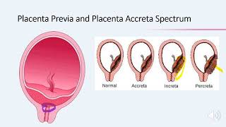 Termination of pregnancy in patients with placenta previa and placenta accreta spectrum  Webinar [upl. by Iteerp]