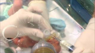 Neonatal Digital Intubation Part 2 [upl. by Ainotal891]