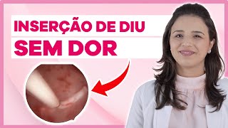 Quando colocar DIU por histeroscopia Vídeo com cirurgia [upl. by Gagnon218]