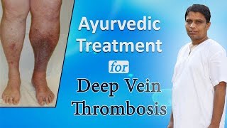 Ayurvedic Treatment for Deep Vein Thrombosis  Acharya Balkrishna [upl. by Erlene]