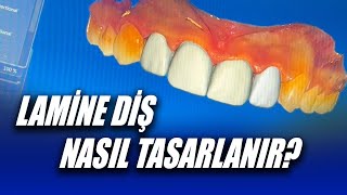 Lamine Diş Tasarımı Nasıl Yapılır Dijital Diş Tasarımı Gülüş Tasarımı Dijitalde Nasıl Yapılır [upl. by Tamsky198]