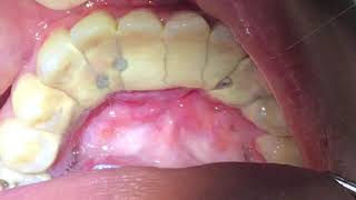 Houston Cosmetic DentistWorst Tartar I have seen Watch how we remove it [upl. by Eahsal]