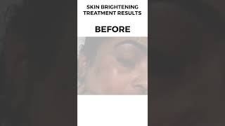 Skin Brightening Treatment Before amp After Result Shared By American Aesthetic skinbrightening skin [upl. by Adnohsirk181]