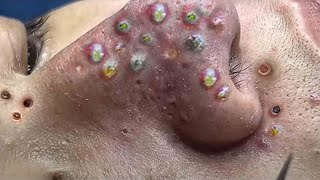 Big Cystic Acne Blackheads Extraction Blackheads amp Milia Whiteheads Removal Pimple Popping  2367 [upl. by Ytteb722]