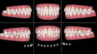 INVISALIGN Design the perfect clincheck and sequence of movements [upl. by Ettedanreb]