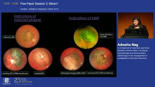 5 A comparison of treatment outcomes between notched Iodine125 plaque brachytherapy and external b [upl. by Tse852]