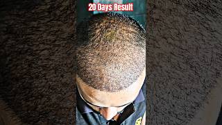 After 20 Days Hair Transplant Result instagram reels video shortvideo [upl. by Nnairrek]