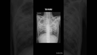 TBC PARU xray radiology chest röntgen tbc paruparu [upl. by Ahsircal]