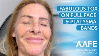 Fabulous Tox on Full Face amp Platysma Bands [upl. by Ocer328]