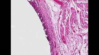 Histopathology Lung Squamous cell carcinoma [upl. by Viole671]