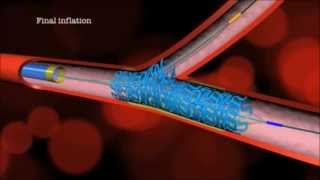 Main Branch Bifurcation Stent quotPROVISIONALquot by Advanced Bifurcation Systems [upl. by Nnawtna]