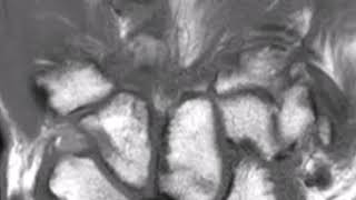 Avascular necrosis lunate bone Kienbocks Disease [upl. by Idnar]