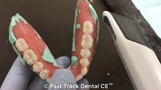 Scanning Radiopaque PVS Relined Denture with TRIOS amp Guide Workflow [upl. by Milena]