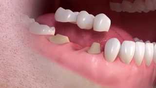 Straumann  Conventional 3unit bridge treatment [upl. by Barth]