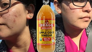 A Whole Week Of Apple Cider Vinegar On My Face To Get Rid Of ACNE SEE MY RESULT [upl. by Ainesey]