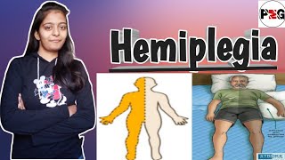 HemiplegiaHemiplegia In HindiTypesCausesSign amp SymptomsDignosisManagement Of Hemiplegia🔥 [upl. by Ecienal]