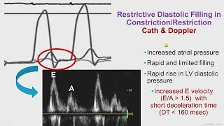 Constrictive Pericarditis [upl. by Anglim920]