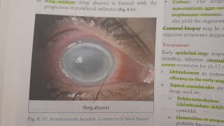 Acanthamoeba Keratitis  EYE [upl. by Surdna]