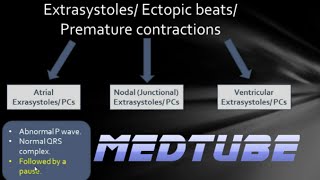 ECGs abnormal rhythms Extrasystoles [upl. by Sabas]