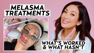 My Melasma Treatment Journey What Actually Worked to Treat Hyperpigmentation  Skincare Susan Yara [upl. by Aistek]