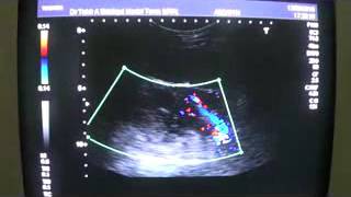 BOSNIAK RENAL CYST TYPE 11 [upl. by Jordana]