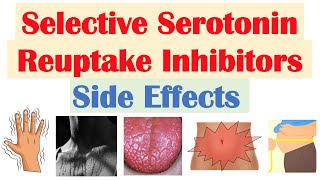 SSRI Antidepressant Side Effects amp Why They Occur  Fluoxetine Paroxetine Sertraline Citalopram [upl. by Leighton]