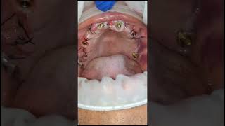 All on 6 maxilla all on 5 mandibledental implant healing and healing cap removal 2nd day shorts [upl. by Oeram]