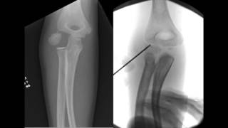 Percutaneous Screw Fixation of Lateral Condylar Humeral Fractures [upl. by Asilem]