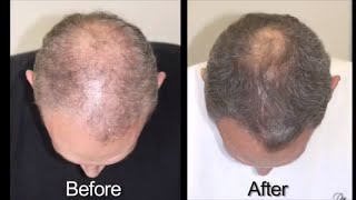 Hair Loss Treatment for Men with Advanced Trichology [upl. by Catton]